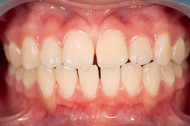 Frenectomy
