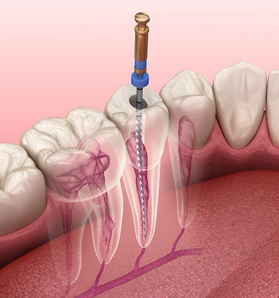 root canal treatment masakalipalayam coimbatore