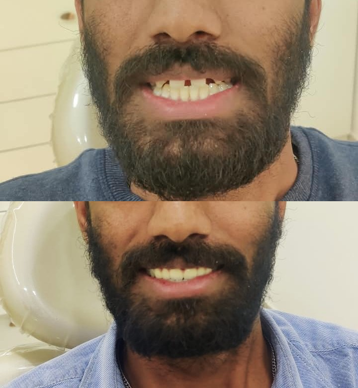 efore and after 1 new